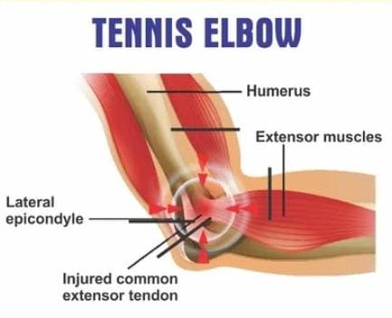 Tennis Elbow Kit