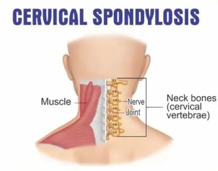 Cervical Spondylosis Kit