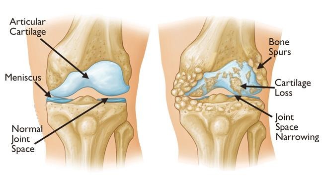 O.A. Knee Kit