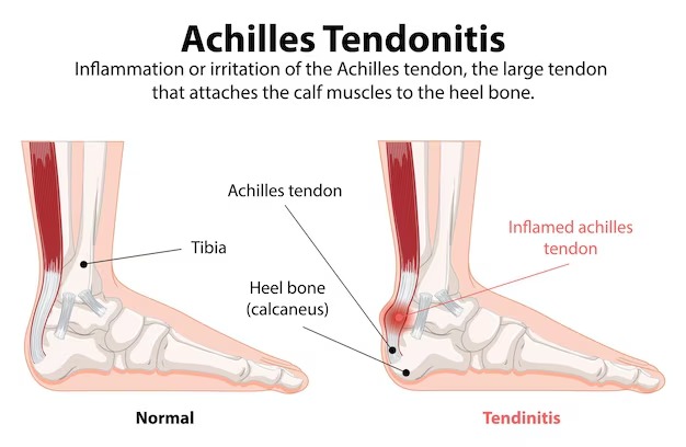 Affected Areas in Tendinitis