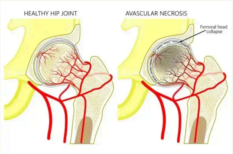 AVN Bone Damage