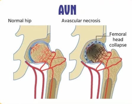 AVN Kit