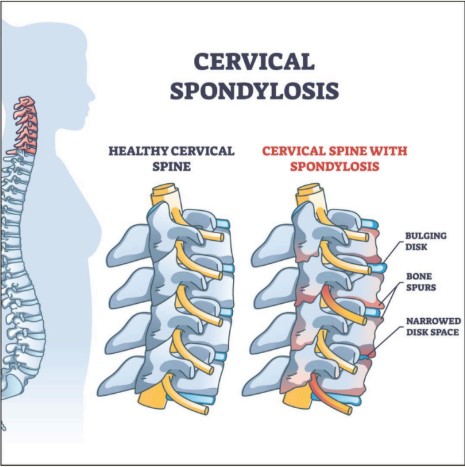 Cervical Spondylosis Diagram