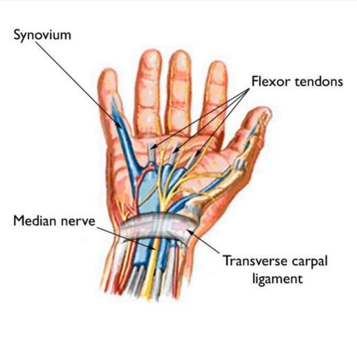 Carpal Tunnel Syndrome