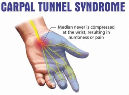 Carpal Tunnel Syndrome Kit