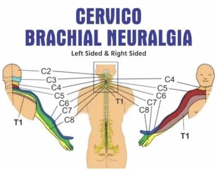 Cervico Brachial Neuralgia Kit