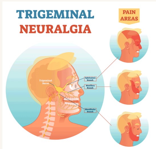 Pain Areas Trigeminal Neuralgia