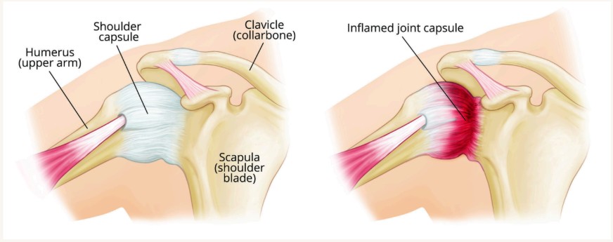 Frozen Shoulder Image