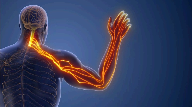 Cervico-Brachial Neuralgia Info