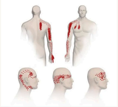 Cervico-Brachial Pain Pattern