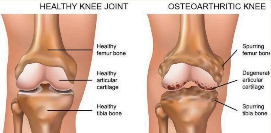 O.A. Knee Image 1