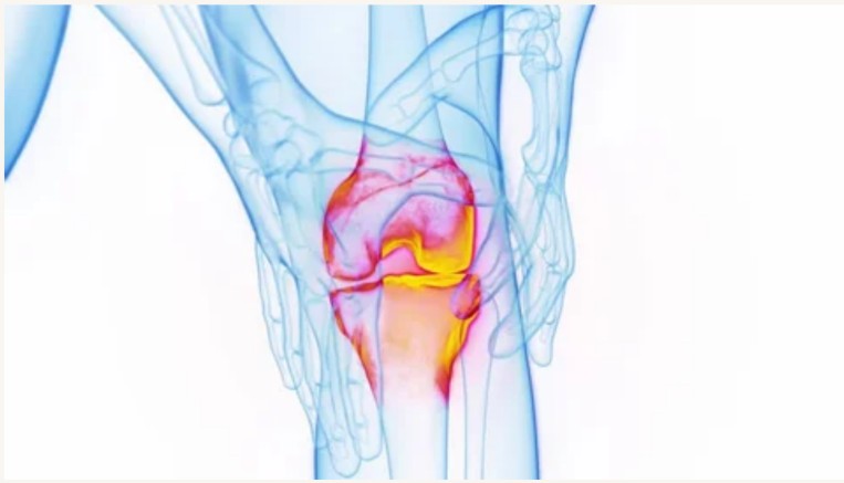O.A. Knee with Gout Image 2