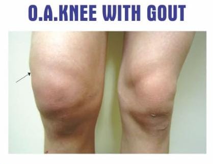 O.A. Knee with Gout Kit