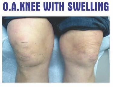 O.A. Knee with Swelling Kit