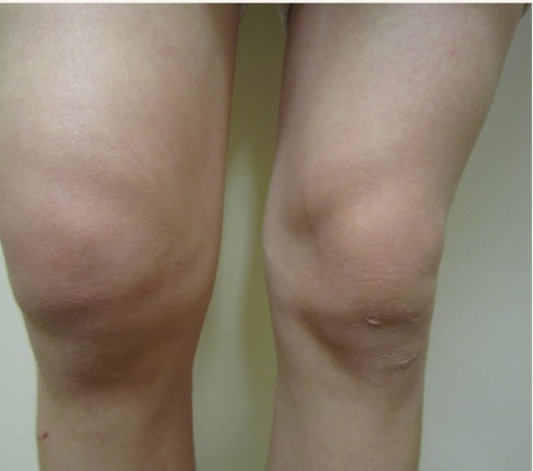 O.A. Knee with Swelling Image 1