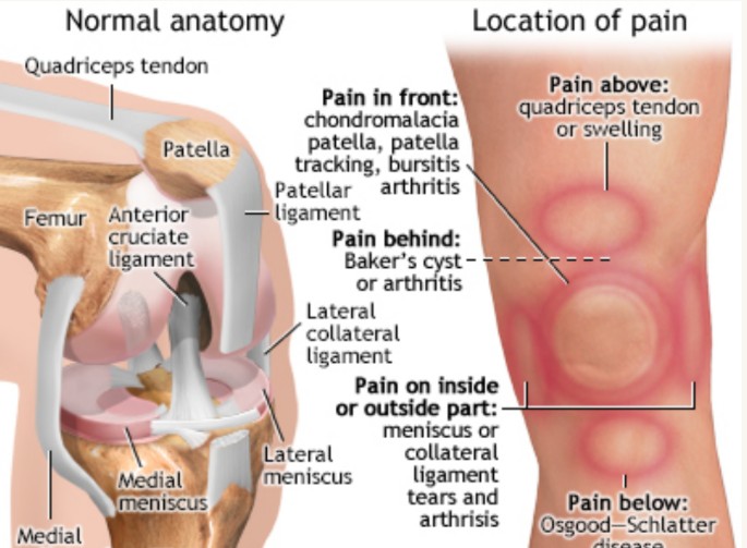 O.A. Knee with Swelling Image 2