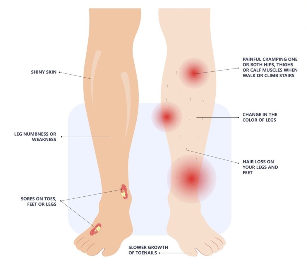 Affected Leg Arteries