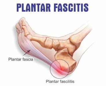 Plantar Fasciitis Kit