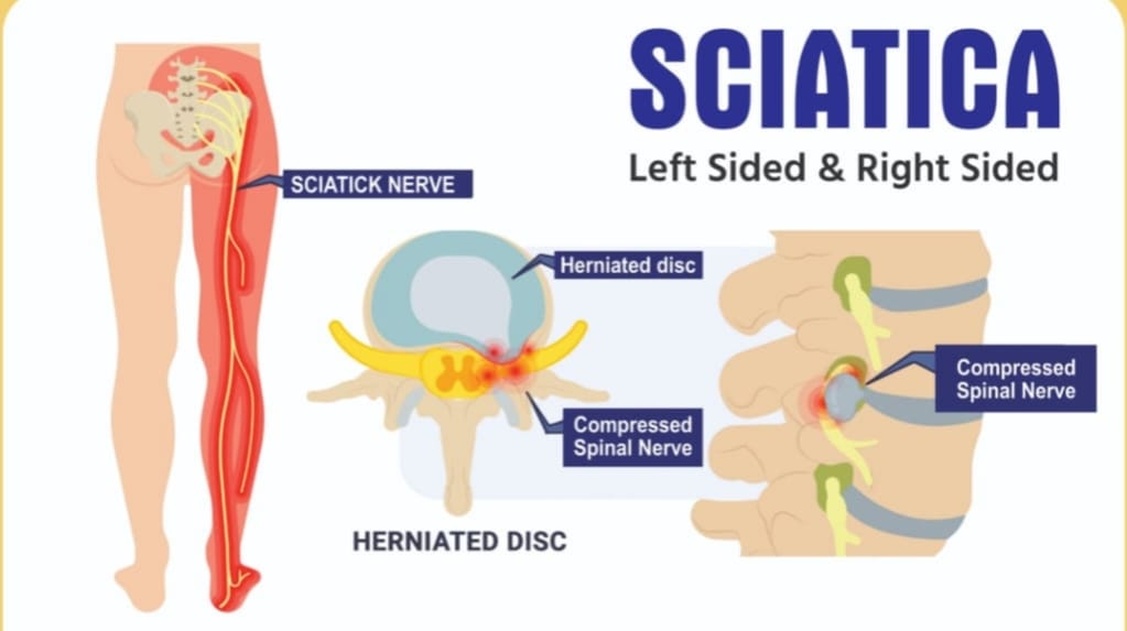 Sciatica Kit