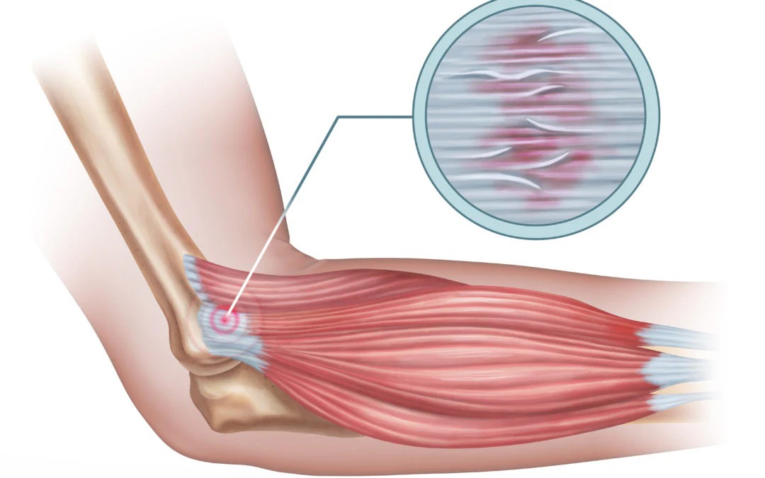 Tendinitis Kit