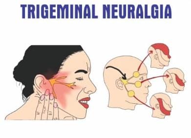 Trigeminal Neuralgia Kit