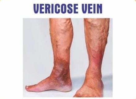 Vericose Vein Kit