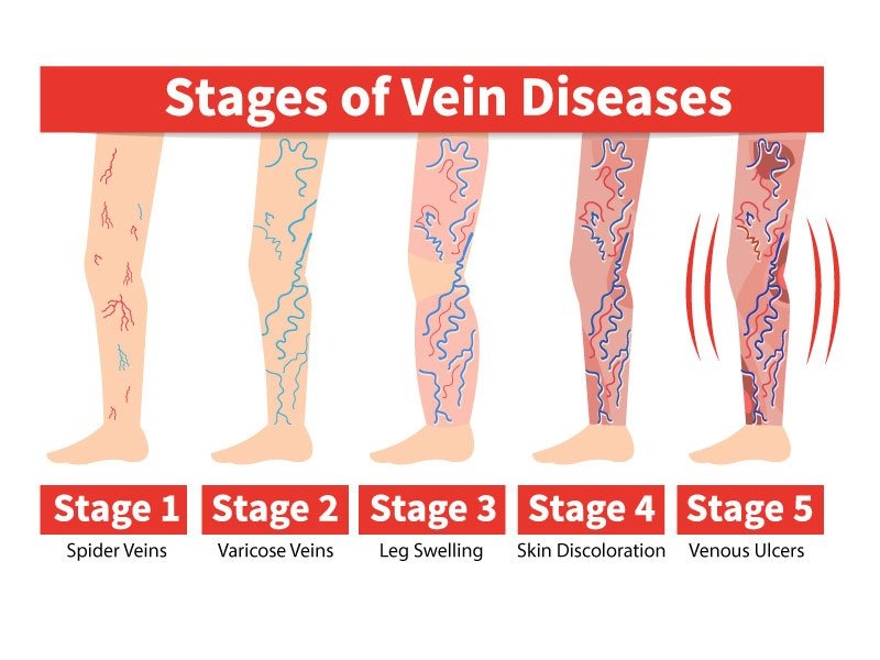 Stages of Vein Diseases